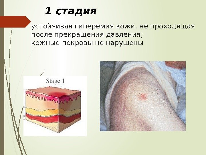 устойчивая гиперемия кожи, не проходящая после прекращения давления;  кожные покровы не нарушены 1