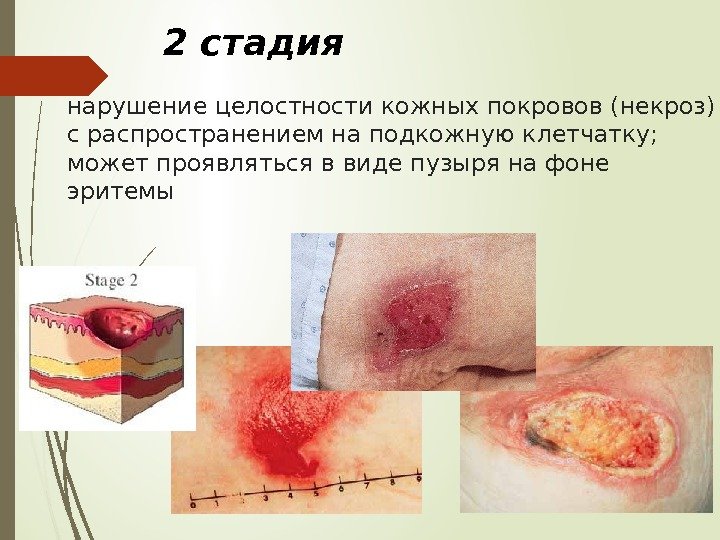 нарушение целостности кожных покровов (некроз) с распространением на подкожную клетчатку; может проявляться в виде