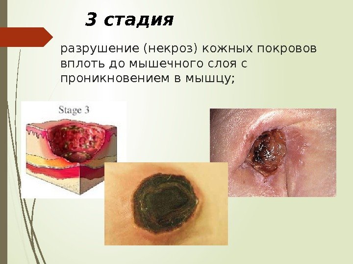 разрушение (некроз) кожных покровов вплоть до мышечного слоя с проникновением в мышцу;  3
