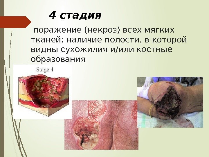  поражение (некроз) всех мягких тканей; наличие полости, в которой видны сухожилия и/или костные