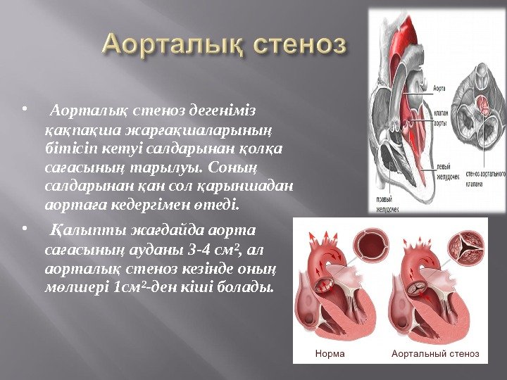   Аорталы стеноз дегеніміз қ а па ша жар а шаларыны  қ