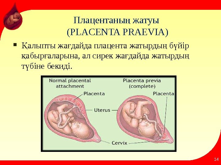 Плацентаны жатуы ң ( PLACENTA PRAEVIA ) алыпты жа дайда плaцента жатырды б йір