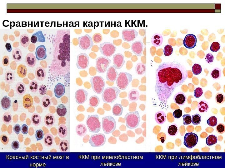 Красный костный мозг в норме ККМ при лимфобластном лейкозе. ККМ при миелобластном лейкозе. Сравнительная