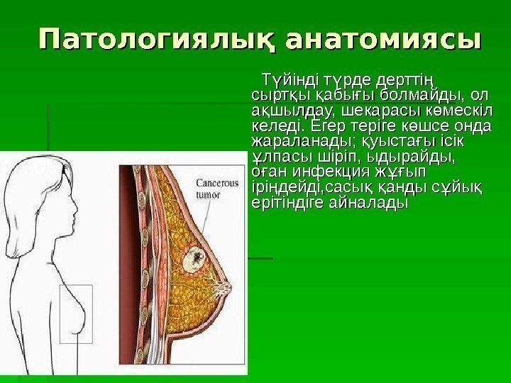 Патологиялық анатомиясы   Т йінді т рде дертті ү ү ң сырт ы