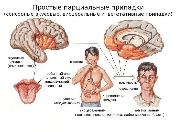   Простые парциальные припадки (сенсорные вкусовые, висцеральные и вегетативные припадки) необычный или неприятный