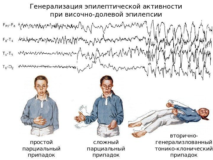   Генерализация эпилептической активности при височно-долевой эпилепсии простой парциальный припадок сложный парциальный припадок