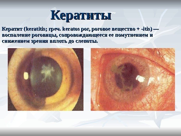Кератиты Кератит (keratitis; греч. keratos рог, роговое вещество + -itis) — воспаление роговицы, сопровождающееся