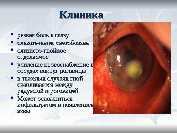 Клиника резкая боль в глазу слезотечение, светобоязнь слизисто-гнойное отделяемое усиление кровоснабжение в сосудах вокруг
