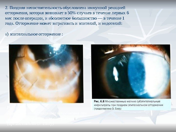 2. Поздняя несостоятельность обусловлена иммунной реакцией отторжения, которая возникает в 50 случаев в течение