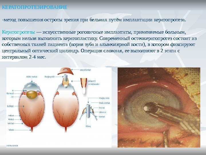 КЕРАТОПРОТЕЗИРОВАНИЕ -метод повышения остроты зрения при бельмах путём имплантации кератопротеза. Кератопротезы — искусственные роговичные