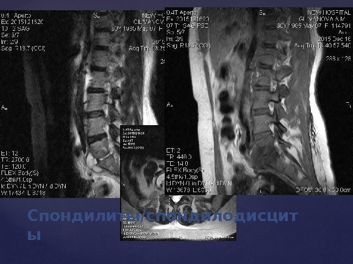 Спондилиты/спондилодисцит ы 