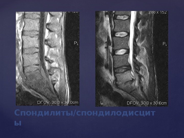 Спондилиты/спондилодисцит ы 