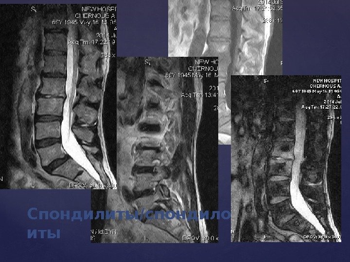 Спондилиты/спондилодисц иты 