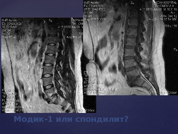 Модик-1 или спондилит? 