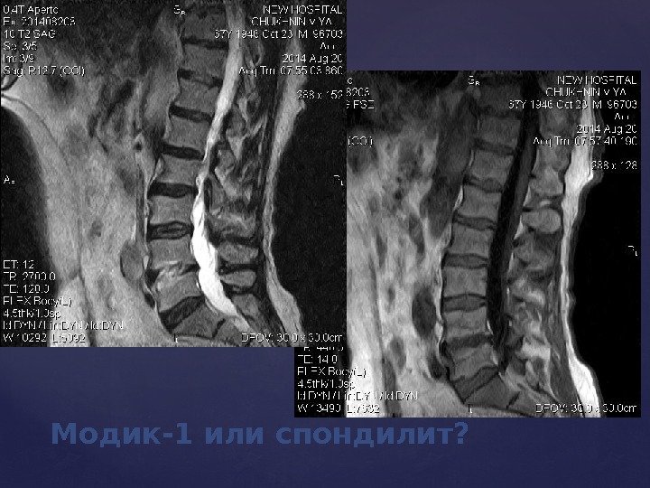 Модик-1 или спондилит? 