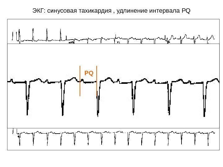 ЭКГ: синусовая тахикардия , удлинение интервала PQ PQ 