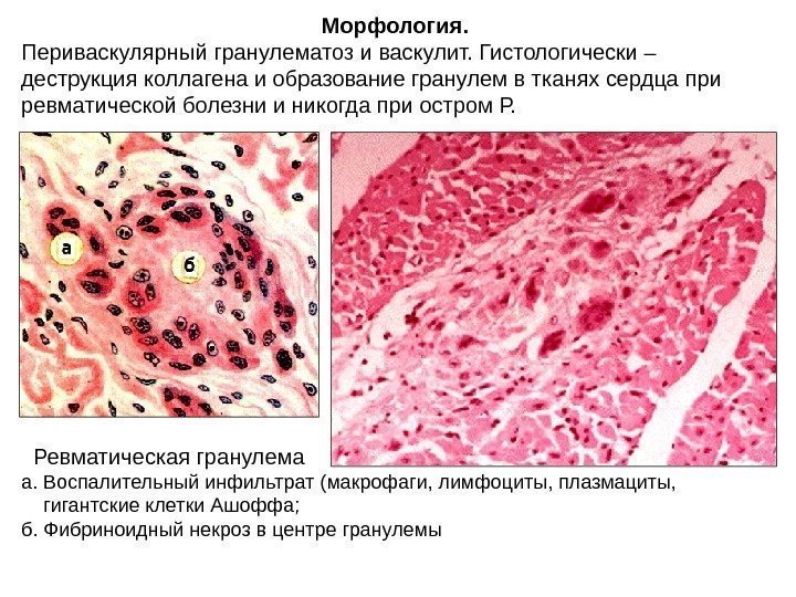  Ревматическая гранулема а. Воспалительный инфильтрат (макрофаги, лимфоциты, плазмациты,  гигантские клетки Ашоффа;