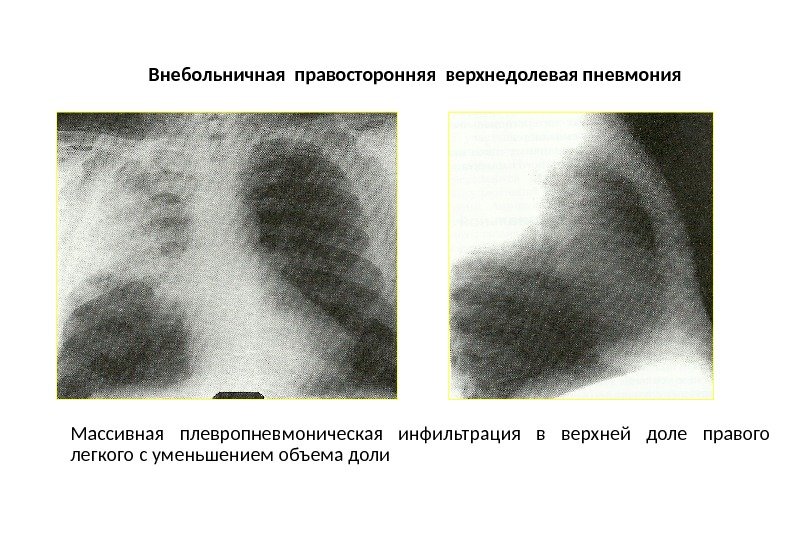 Внебольничная правосторонняя верхнедолевая пневмония Массивная плевропневмоническая инфильтрация в верхней доле правого легкого с уменьшением