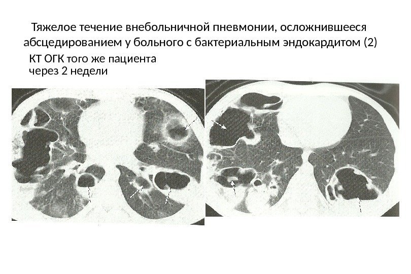 Тяжелое течение внебольничной пневмонии, осложнившееся  абсцедированием у больного с бактериальным эндокардитом (2) КТ