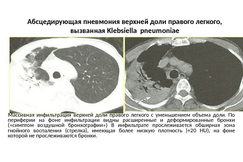 Абсцедирующая пневмония верхней доли правого легкого,  вызванная Klebsiella pneumoniae Массивная инфильтрация верхней доли