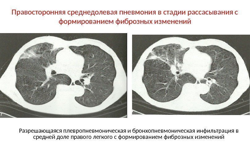 Правосторонняя среднедолевая пневмония в стадии рассасывания с формированием фиброзных изменений Разрешающаяся плевропневмоническая и бронхопневмоническая