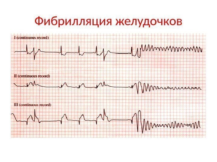 Фибрилляция желудочков 