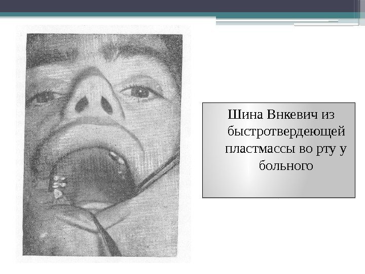 Шина Внкевич из быстротвердеющей пластмассы во рту у больного     1