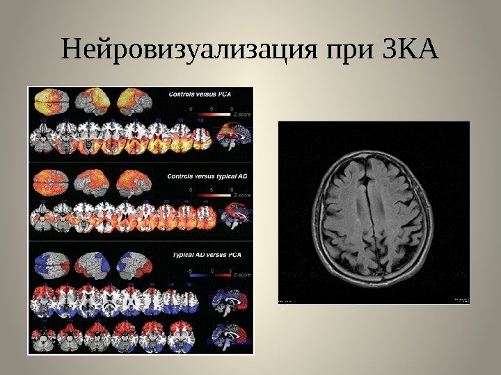 Нейровизуализация при ЗКА 