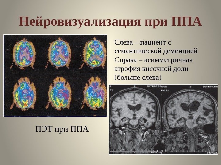 Нейровизуализация при ППА ПЭТ при ППА Слева – пациент с семантической деменцией Справа –