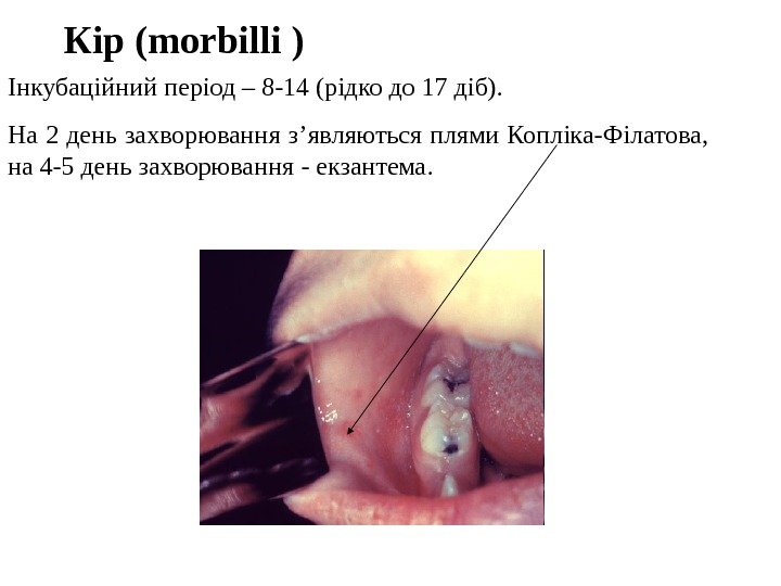   Кір (morbilli ) Інкубаційний період – 8 -14 (рідко до 17 діб).