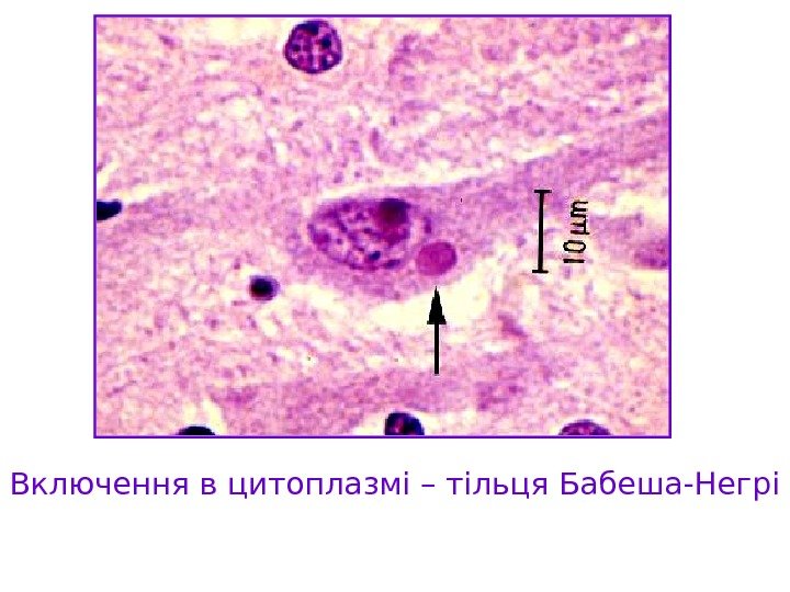   Включення в цитоплазмі – тільця Бабеша-Негрі 