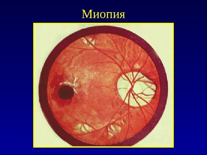 Миопия 