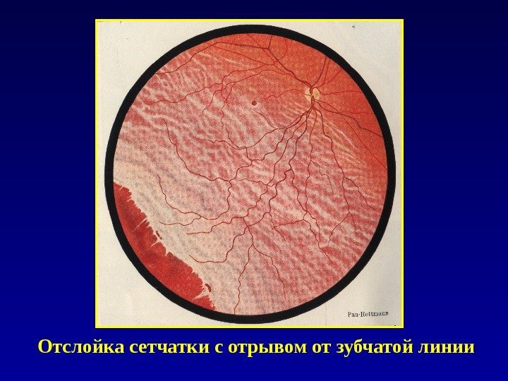 Отслойка сетчатки с отрывом от зубчатой линии 