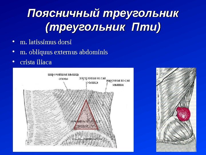 Поясничный треугольник (треугольник Пти) • m.  latissimus dorsi  • m. obliquus externus