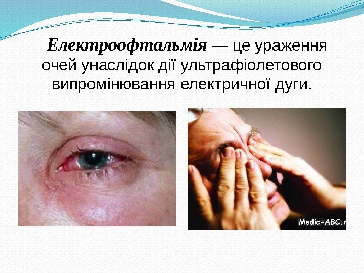 Електроофтальмія — це ураження очей унаслідок дії ультрафіолетового випромінювання електричної дуги. 