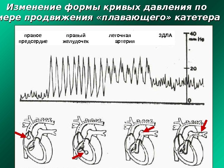 Изменение формы кривых давления по мере продвижения «плавающего» катетера правое   правый 