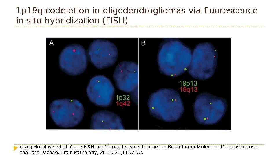 1 p 19 q codeletion in oligodendrogliomas via fluorescence in situ hybridization (FISH) Craig