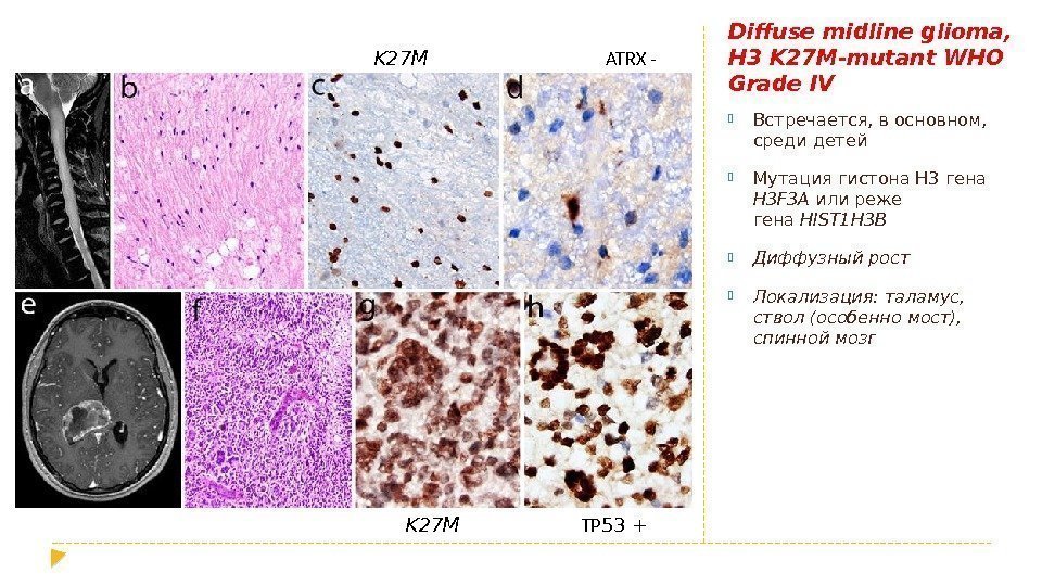 Diffuse midline glioma,  H 3 K 27 M-mutant WHO Grade IV Встречается, в