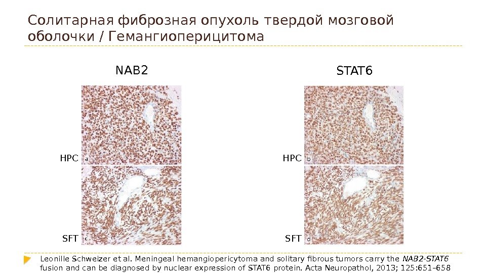 Солитарная фиброзная опухоль твердой мозговой оболочки/ Гемангиоперицитома  NAB 2 STAT 6 HPC SFT