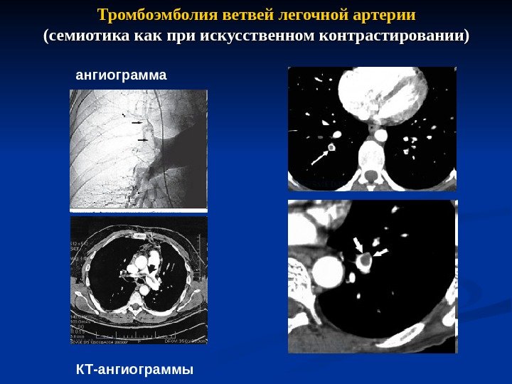 Тромбоэмболия ветвей легочной артерии (семиотика как при искусственном контрастировании) ангиограмма КТ-ангиограммы 