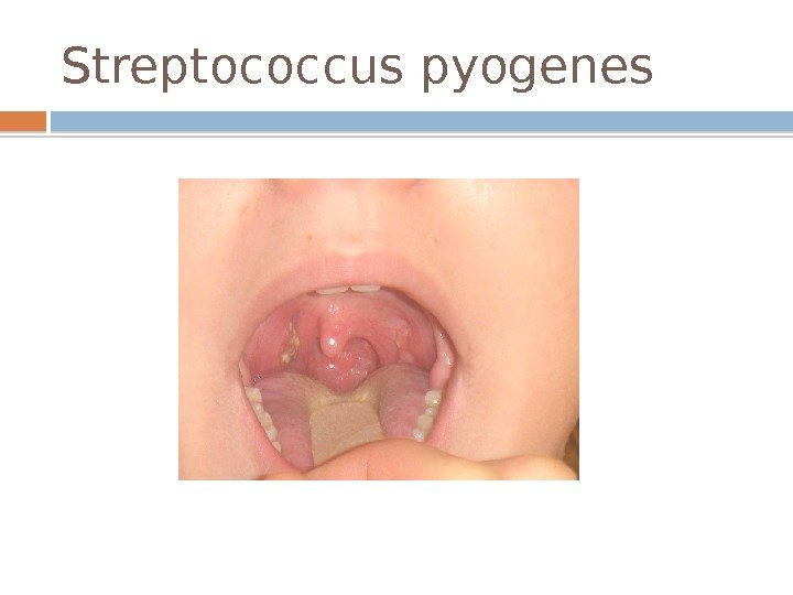 Streptococcus pyogenes  