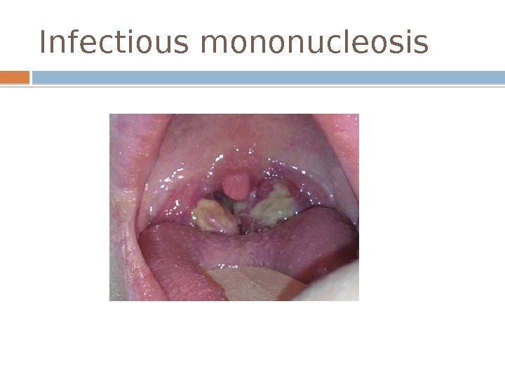 Infectious mononucleosis  