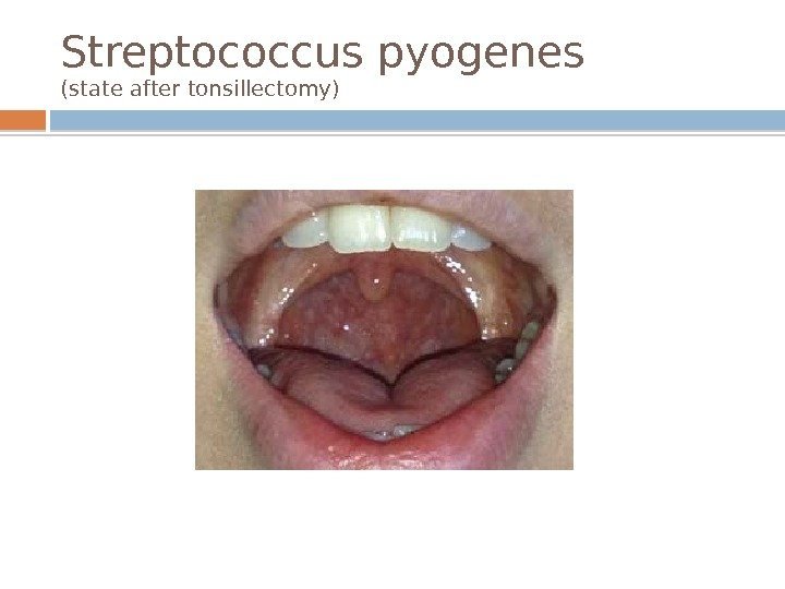 Streptococcus pyogenes (state after tonsillectomy)  