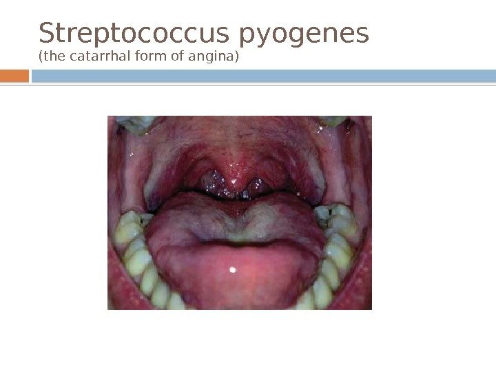 Streptococcus pyogenes (the catarrhal form of angina)  