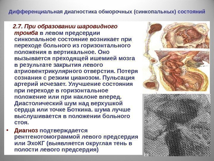 Дифференциальная диагностика обморочных (синкопальных) состояний   2. 7. При образовании шаровидного тромба 