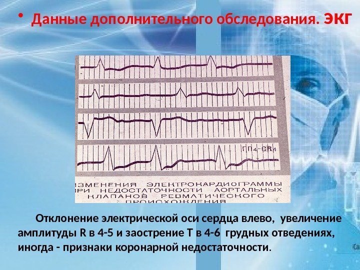  • Данные дополнительного обследования.  экг Отклонение электрической оси сердца влево,  увеличение