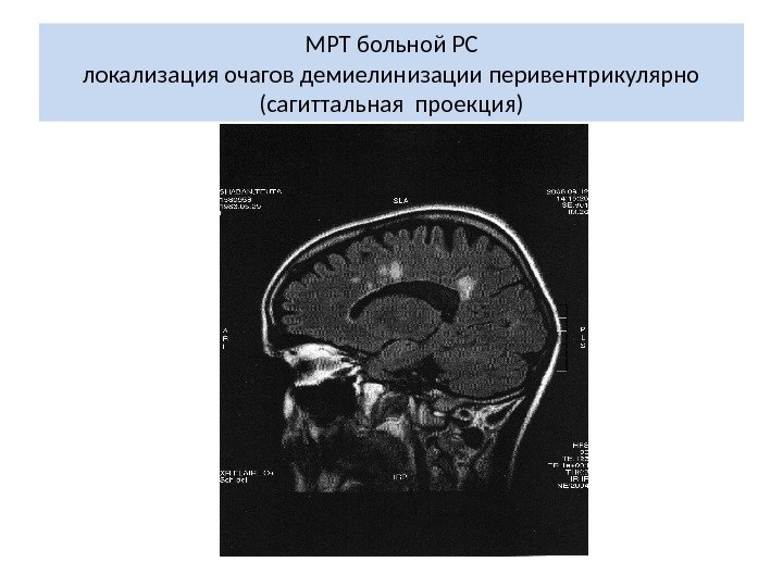 МРТ больной РС локализация очагов демиелинизации перивентрикулярно (сагиттальная проекция) 