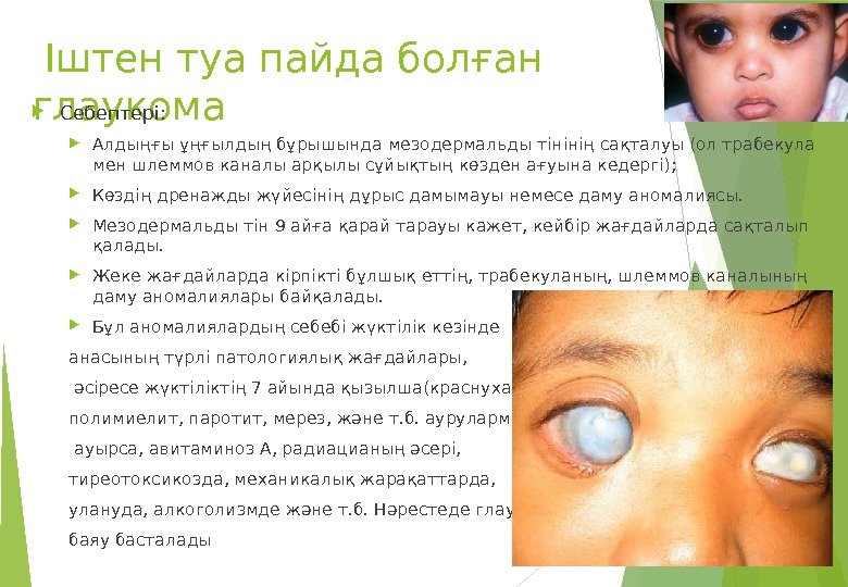  Іштен туа пайда болған глаукома Себептері:  Алдыңғы ұңғылдың бұрышында мезодермальды тінінің сақталуы
