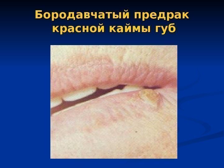 Бородавчатый предрак красной каймы губ 