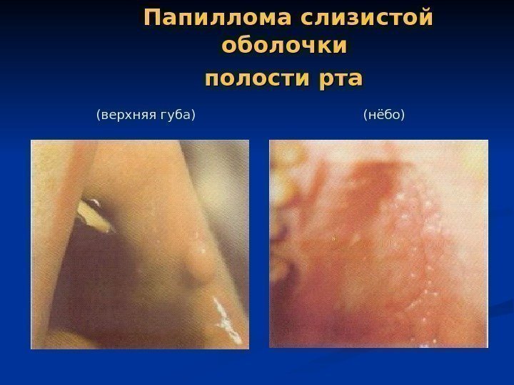 Папиллома слизистой оболочки полости рта  ( нёбо )( верхняя губа ) 